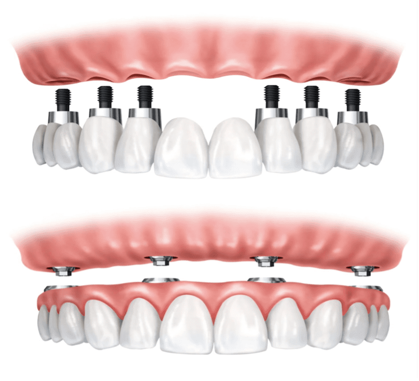 All-on-four implants in Virginia Beach