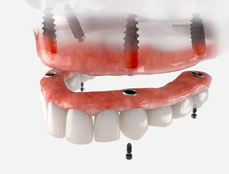 All-on-4 implants and All-on-6 implants support a full arch of teeth