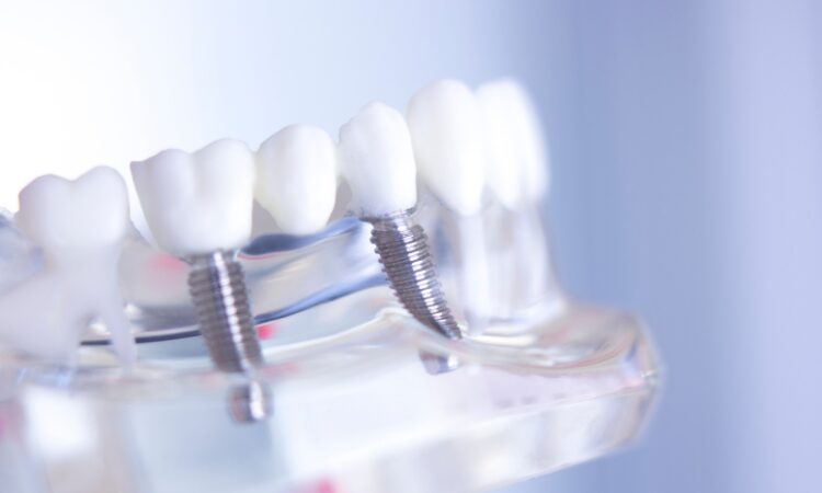 Receiving dental implants under one roof better ensures convenience, quality care, and a cohesive treatment plan.