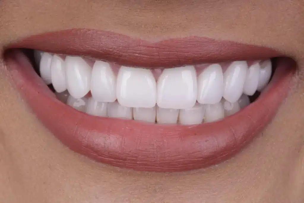 best Teeth Whitening in Virginia Beach VA 2020