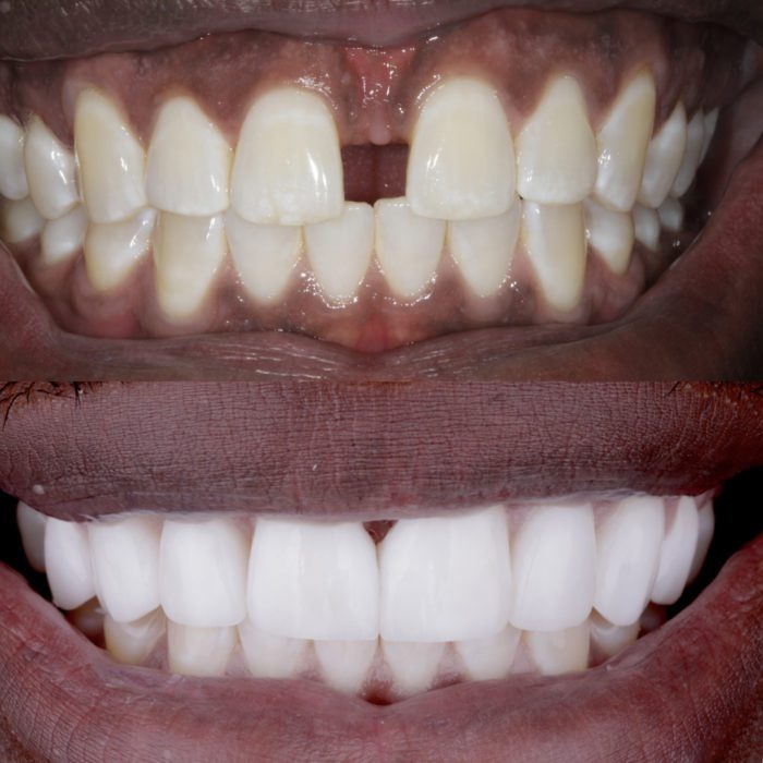 Before and after replacing missing teeth in Virginia Beach
