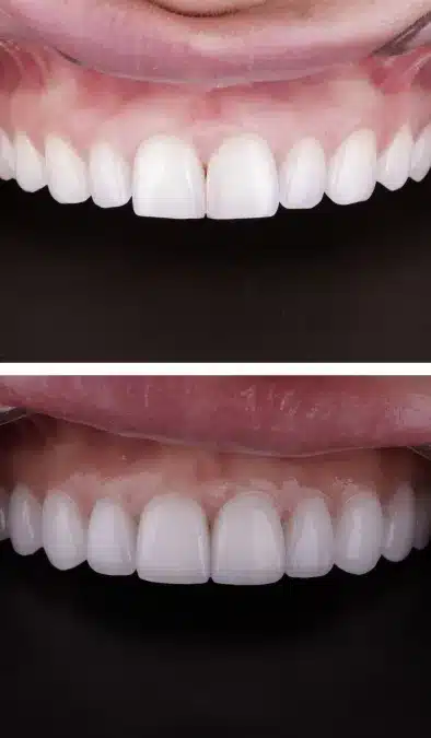 Before and after minimal and no-prep Veneers