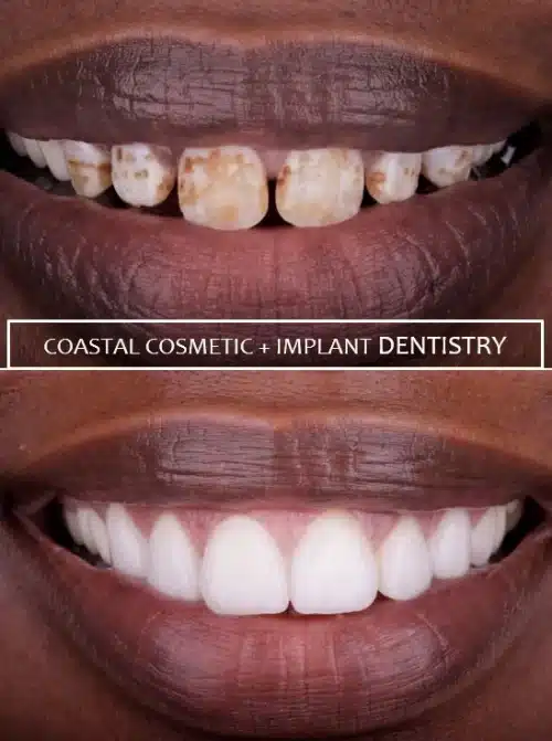 Dental patient before and after dental veneers