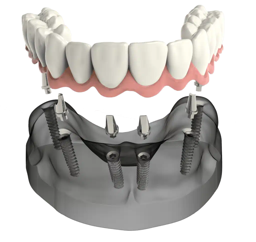 All-On-Four implant dentures in Virginia Beach