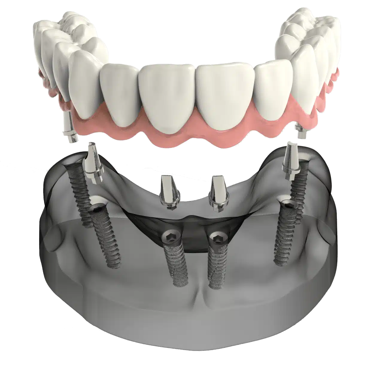 All-On-Four implant dentures Norfolk VA