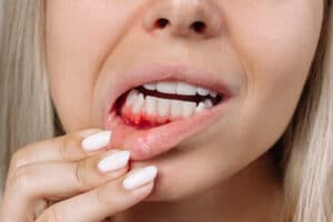 treat your bleeding gums before it becomes gum disease