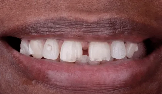 Before dental implant for front tooth