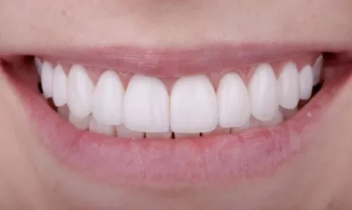 After cosmetic dentistry