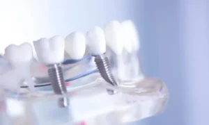 Rediscover Your Smile with Implant Dental Bridges in Virginia Beach, VA