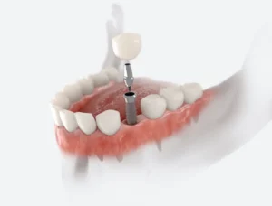 Dental Implants for Younger Adults in Virginia Beach, VA