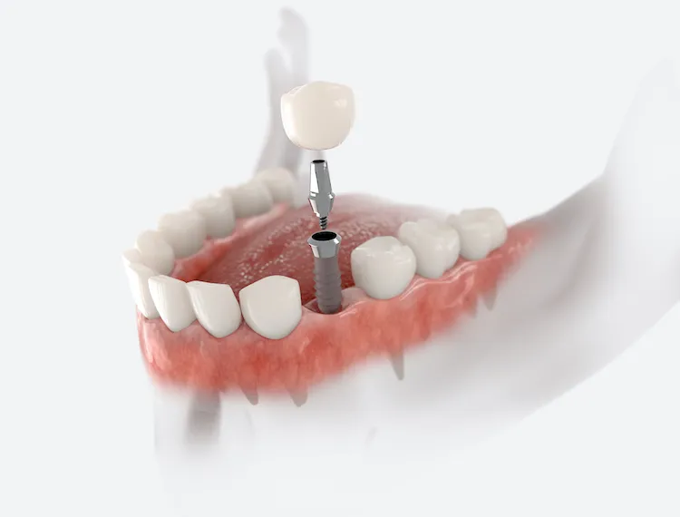 Single Tooth Implant vs. Bridge: Which Is Right for You?