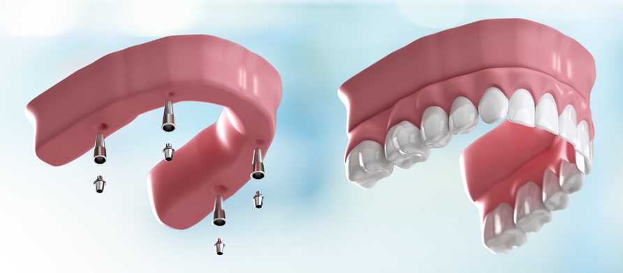 All-on-4 vs. Removable Implant-Supported Dentures: What's the Difference?