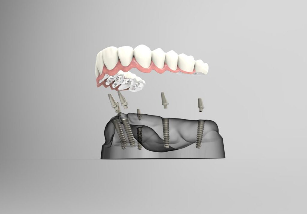 Implant-supported dentures